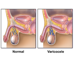 varicocele